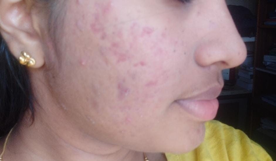 Acne Vulgaris 2